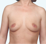 A front view of a Natrelle® breast augmentation patient who has a maximum fullness aesthetic - before treatment.