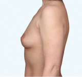 A side view of a Natrelle® breast augmentation patient who has a maximum fullness aesthetic - before treatment.