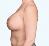 A side view of a Natrelle® breast augmentation patient who has a maximum fullness aesthetic - after treatment.