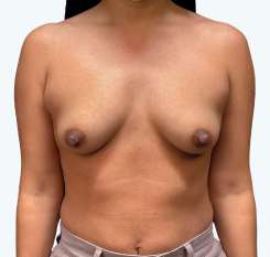 A front view of a Natrelle® breast augmentation patient who has a moderate fullness aesthetic - before treatment.