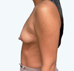 A side view of a Natrelle® breast augmentation patient who has a moderate fullness aesthetic - before treatment.