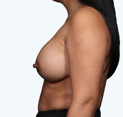 A side view of a Natrelle® breast augmentation patient who has a moderate fullness aesthetic - after treatment.